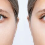 Operácia očných viečok VISUMED